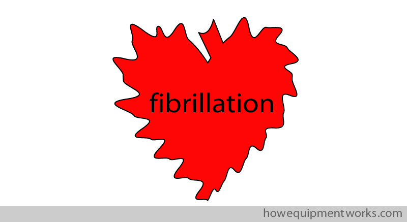 fibrillation_zagged