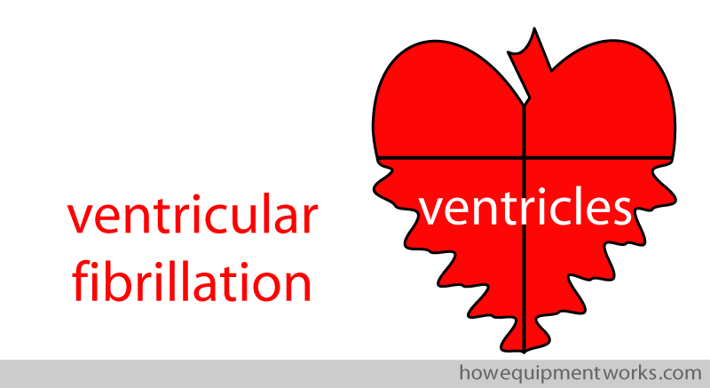vent_fibrillation_chambers
